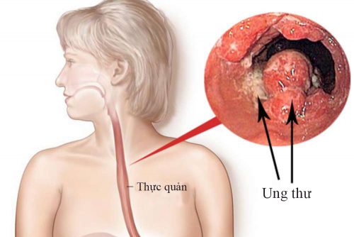 Ảnh 3 của Trào ngược dạ dày thực quản